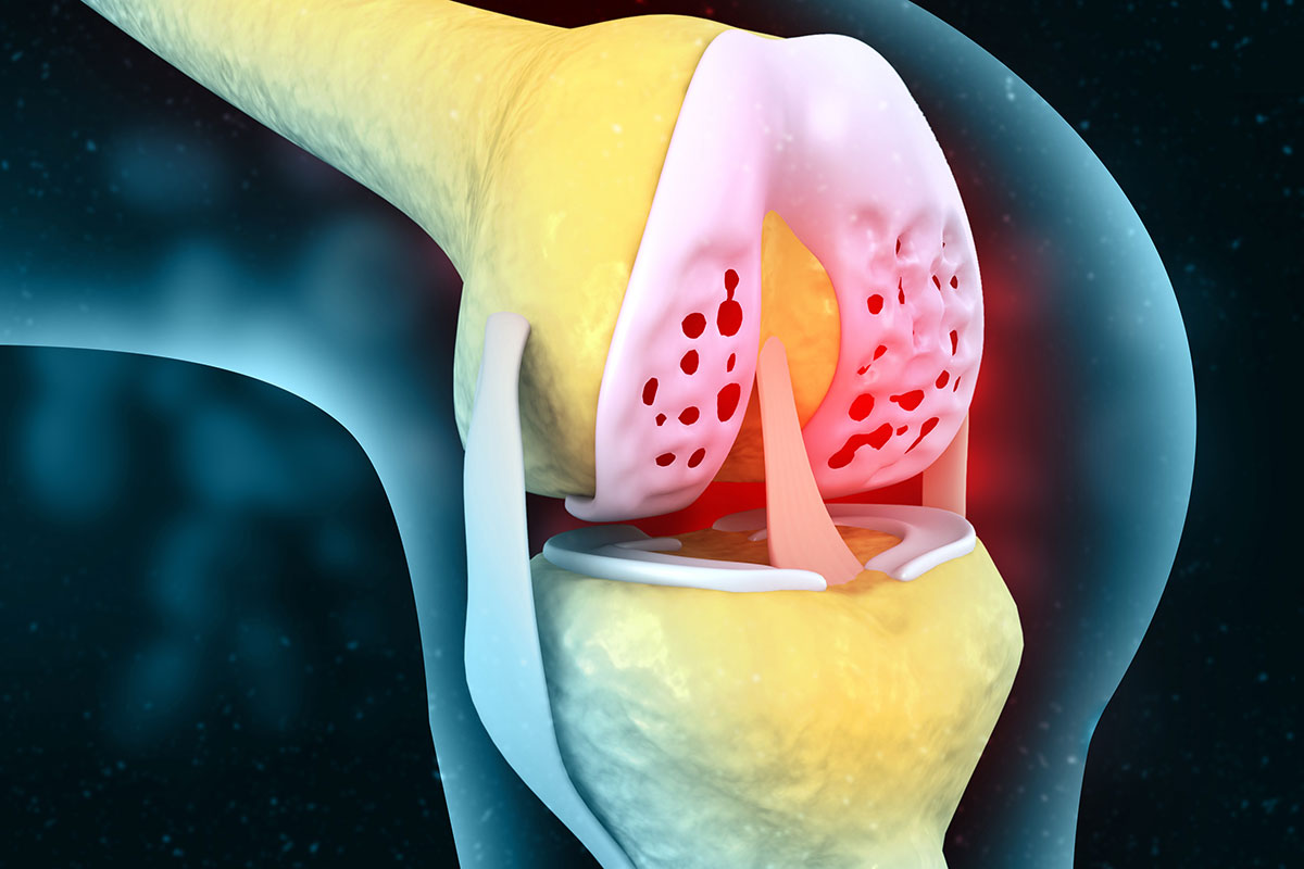 Darstellung von Knorpel im Knie