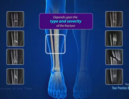 Video zur Tibiafraktur – Der Unterschenkelbruch