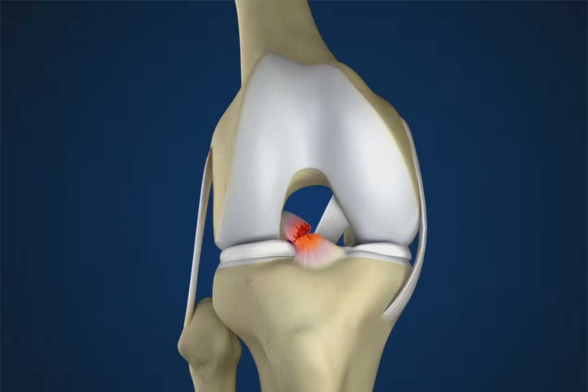 ACL Rekonstruktion Achilles Allotransplantat